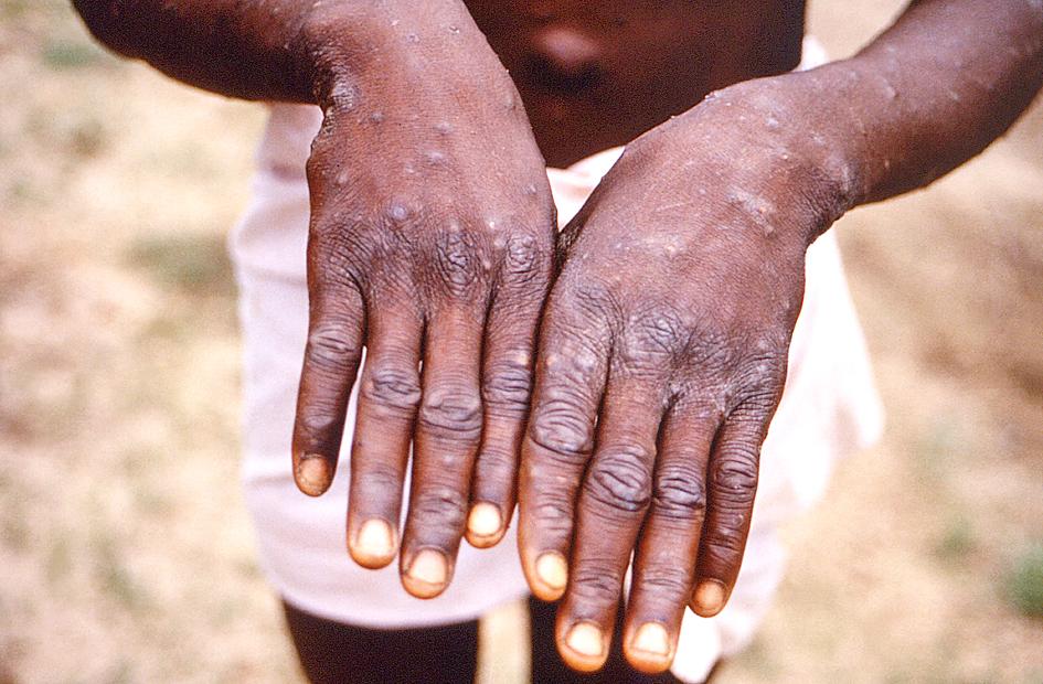 Le CDC émet un avertissement pour 44 États avec des cas de monkeypox